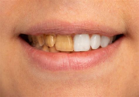 dişlerde kireçlenme nasıl temizlenir